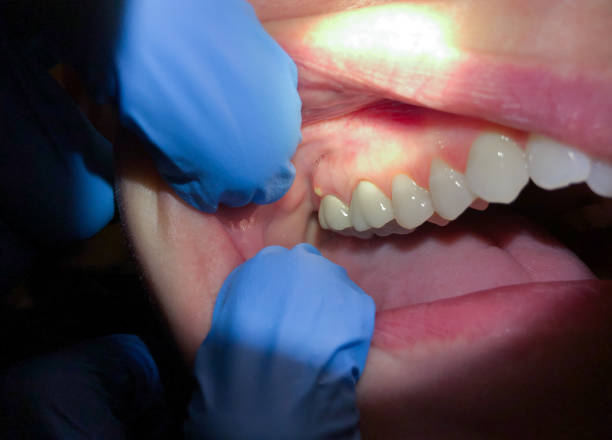 Best Emergency Wisdom Tooth Extraction in Cleburne, TX