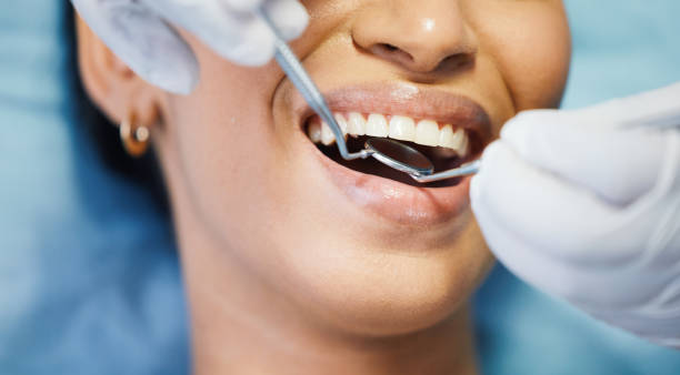 Best Knocked-Out Tooth (Avulsed Tooth) Treatment in Cleburne, TX